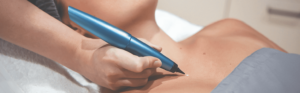 cryopen therapy in London