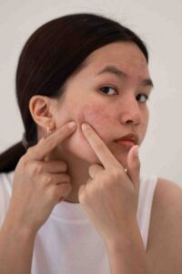 acne treatment queens park